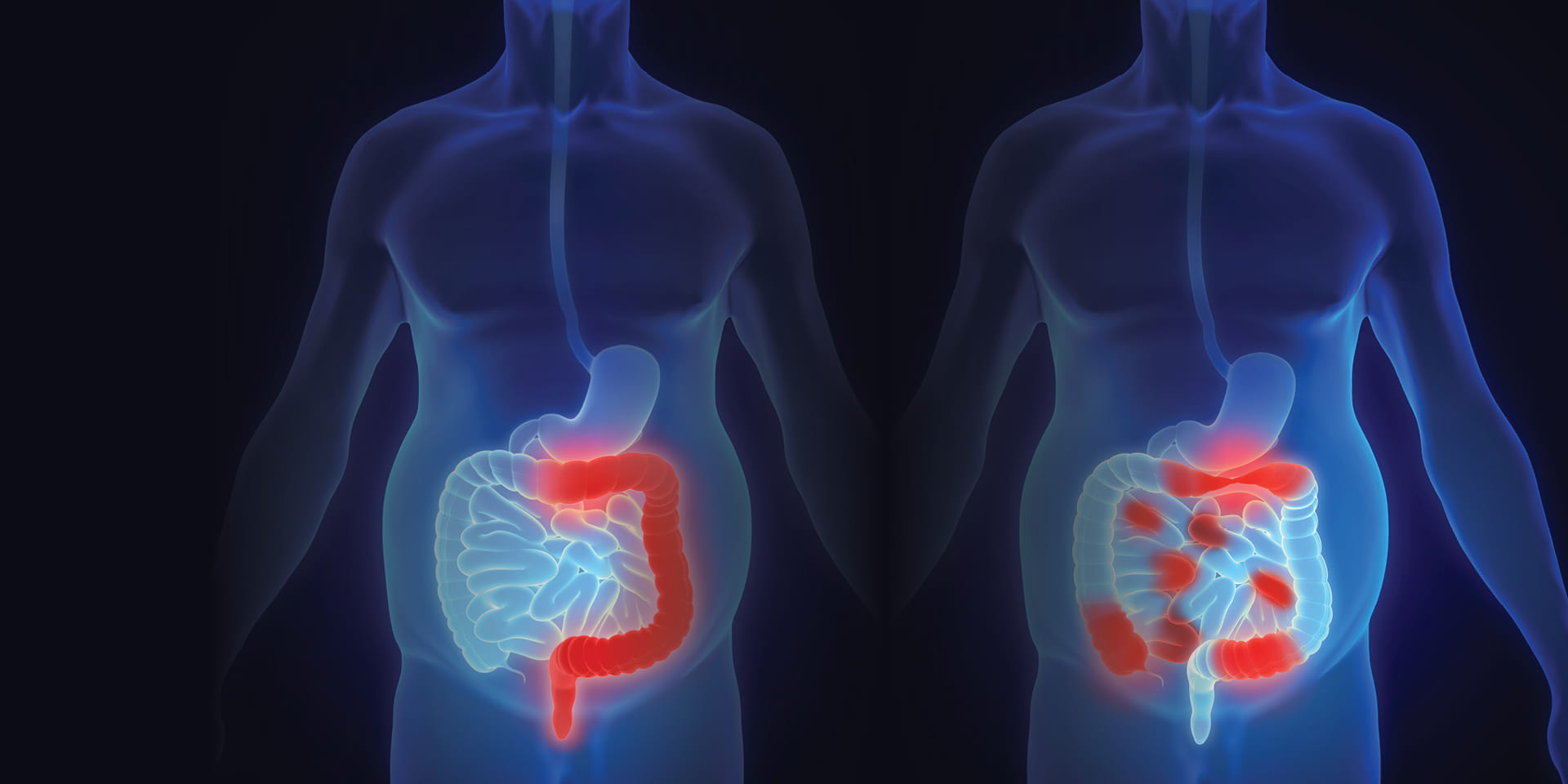 The Crucial Importance of Crohn's Disease and Ulcerative Colitis