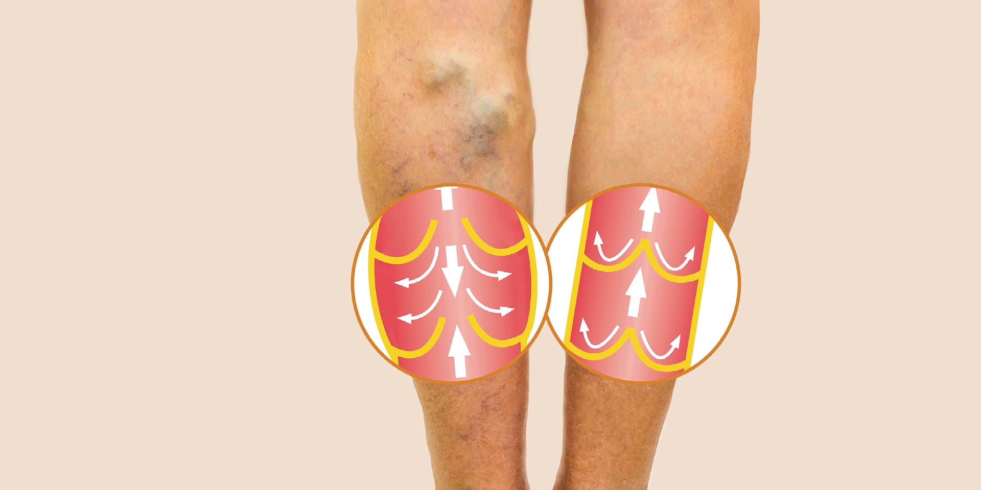 back of legs with varicose veins