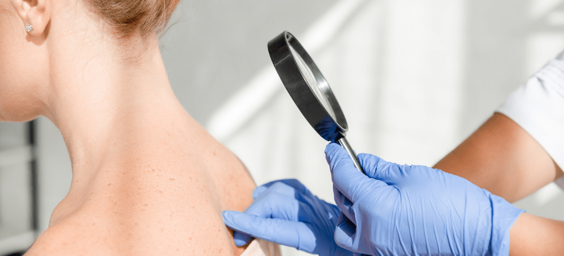 Dermatology provider checking a patient skin for anomalies, cropped view of dermatologist examining skin of patient with magnifying glass in clinic | Doylestown Health