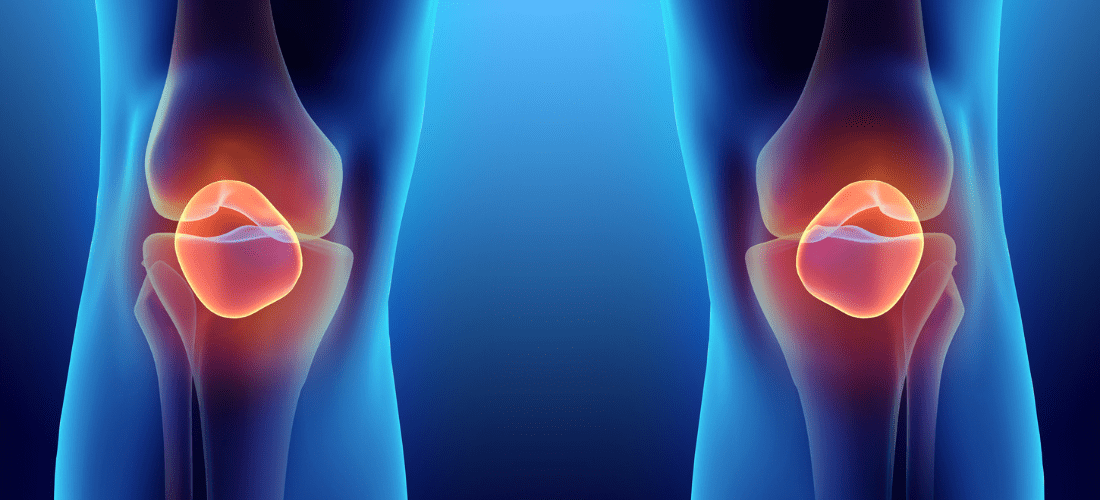 3D illustration of Patella, medical concept, illustration of knee rheumatism | Doylestown Health
