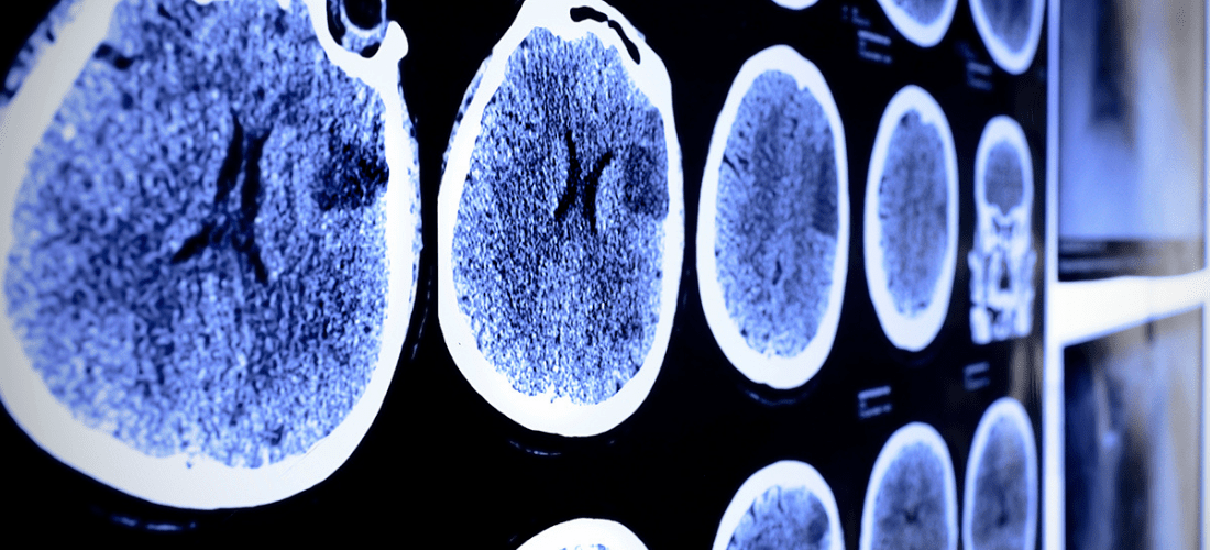 Medical imaging related to stroke | Doylestown Health